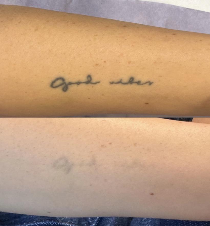 Tatuaje de letras Good vibes en el antebrazo antes y después del láser, casi invisible