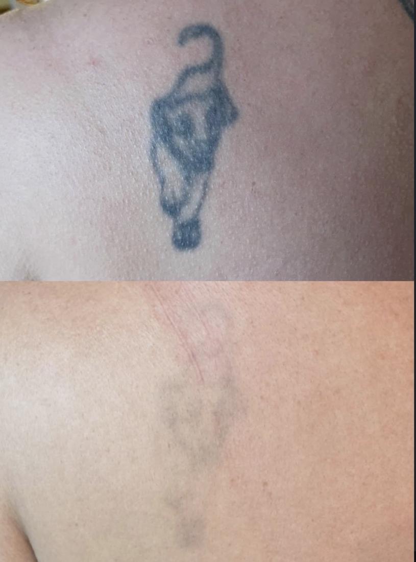Tatuaje de pantera en el hombro antes y después del láser, muy aclarado